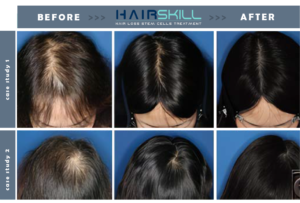 What You Need to Know Before Opting For a Stem Cell Hair Transplant