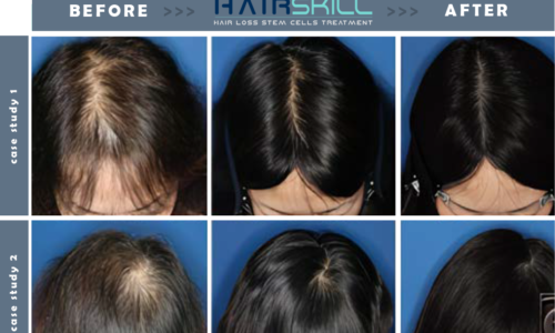 What You Need to Know Before Opting For a Stem Cell Hair Transplant